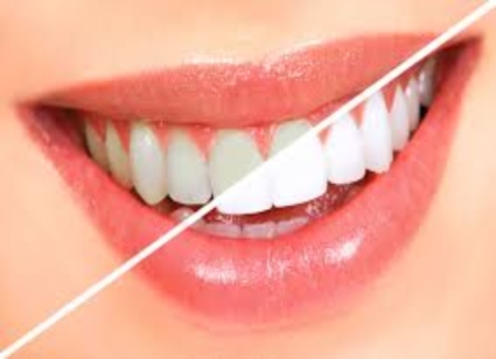 4 Teeth Whitening Tips For A Broader Smile